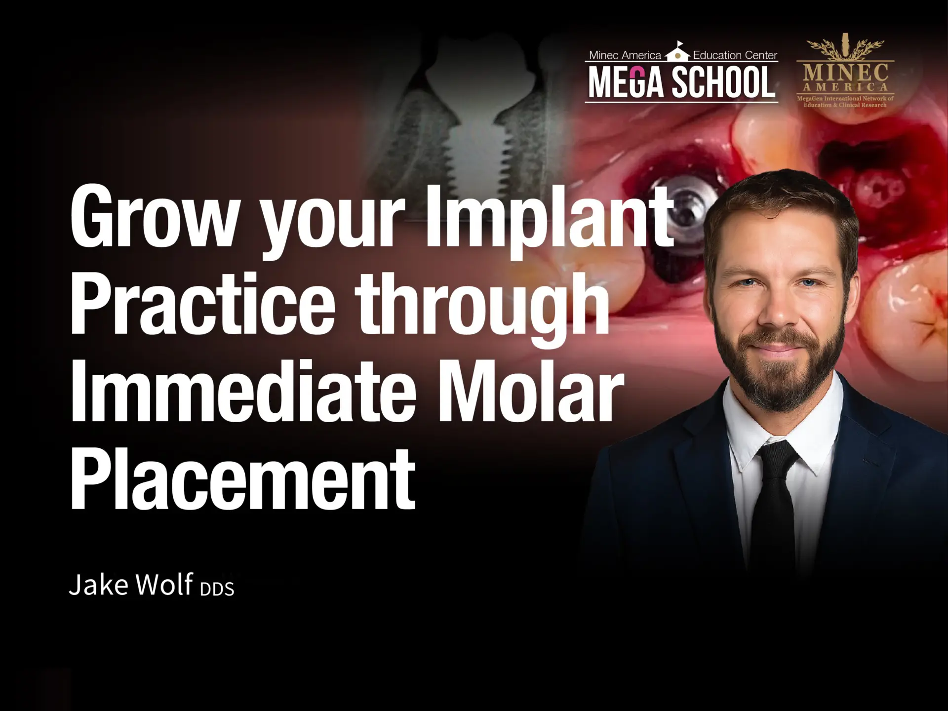 Grow your Implant Practice through Immediate Molar Placement