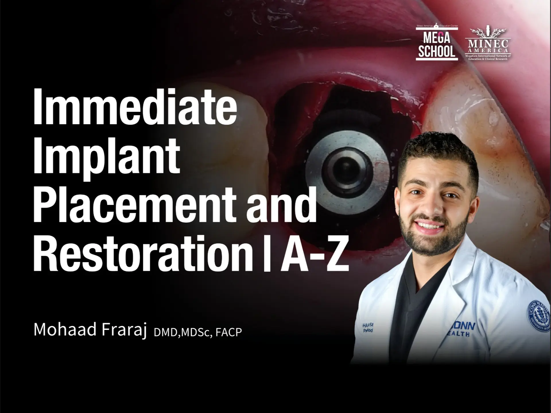Immediate Implant Placement and Restoration | A-Z