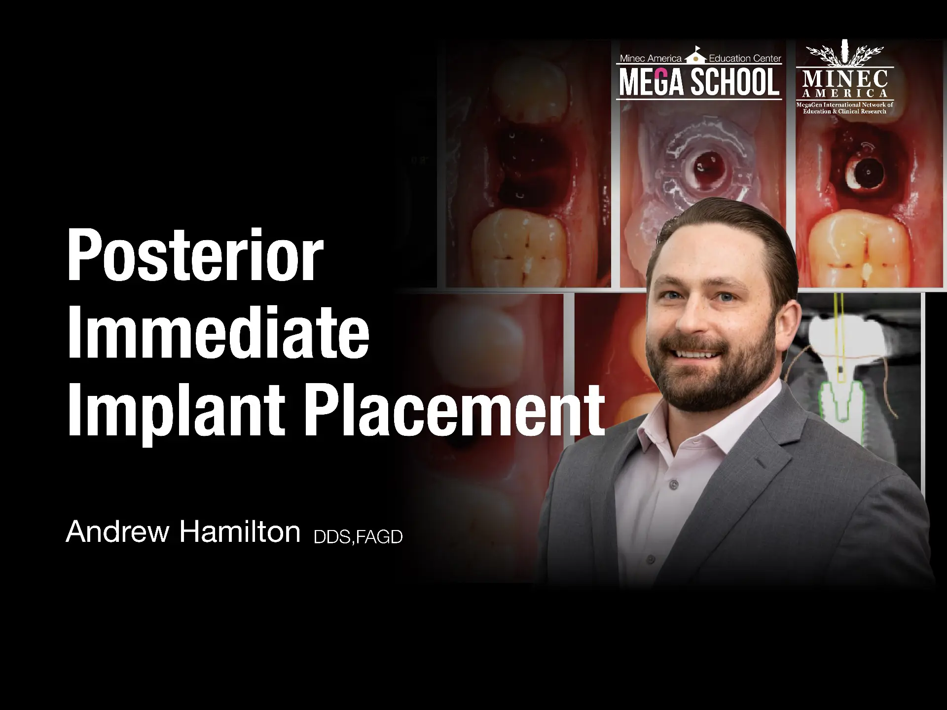 Posterior Immediate Implant Placement -May