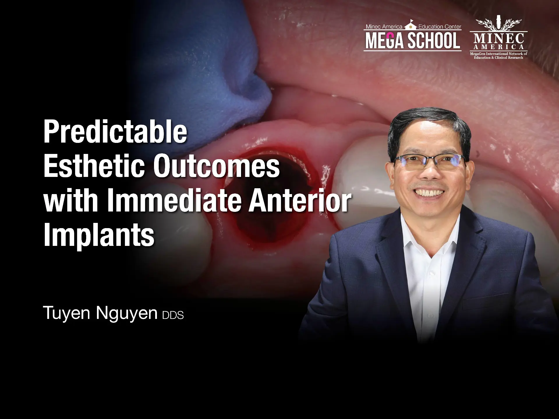 Predictable Esthetic Outcomes with Immediate Anterior Implants:  The Socket Shield Technique