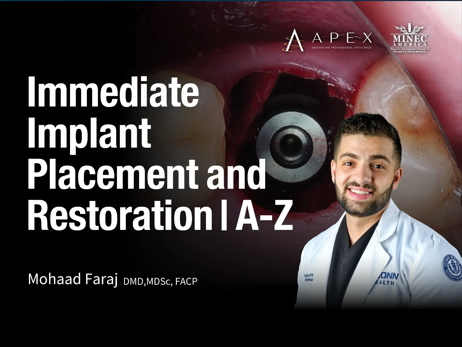 Immediate Implant Placement and Restoration | A-Z 