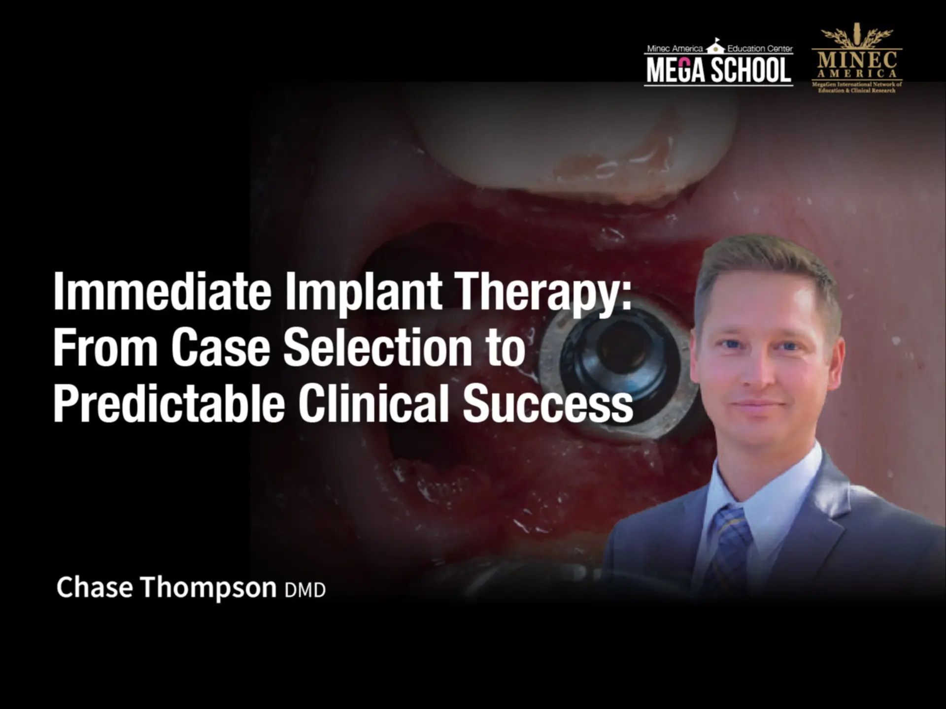 Immediate Implant Therapy: From Case Selection to Predictable Clinical Success